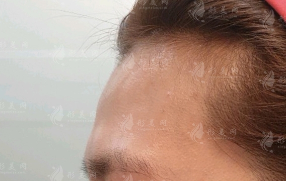 额头填充最新材料，科技塑美，体验未来美学魅力