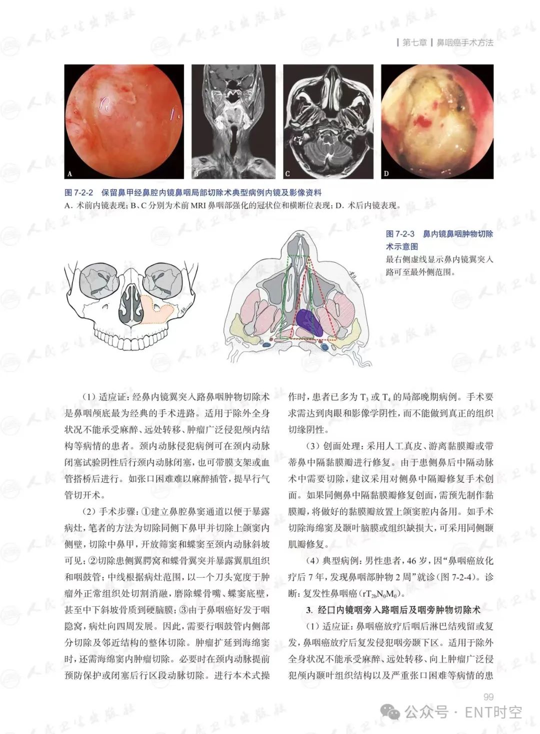 鼻咽癌最新治疗方法，希望之光照亮前行之路